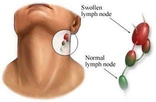 Treatment of Non-Hodgkin's Malignant Lymphoma