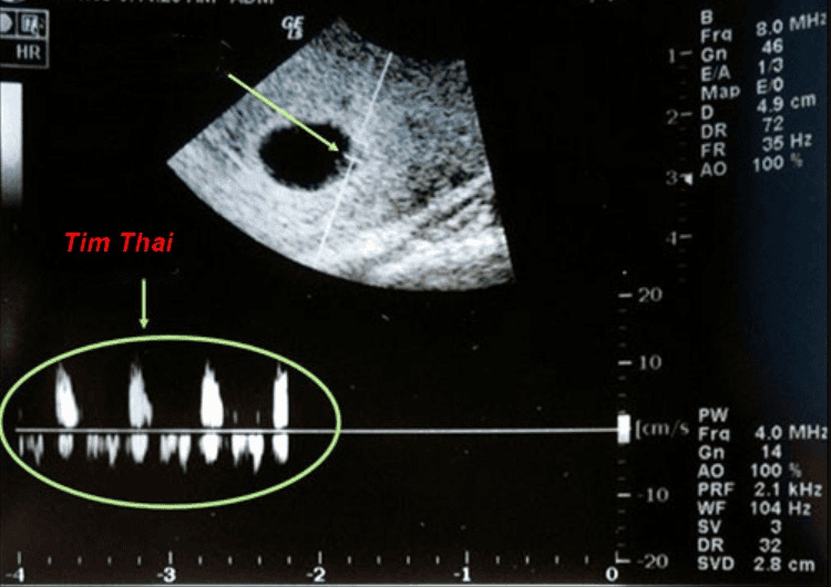 Tổng Hợp Thông Tin Về Siêu Âm Tim Thai