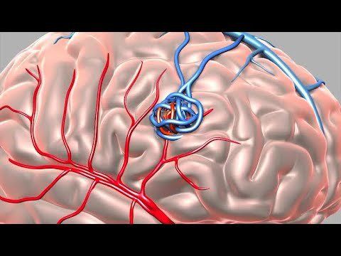 Learn about AVMs (arteriovenous malformations) of the brain