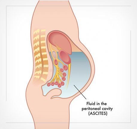 
Bị tăng áp lực ổ bụng là nguyên nhân gây sa trực tràng
