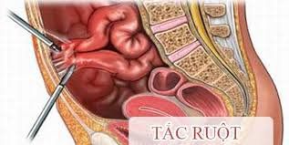 
Tắc ruột có thể xảy ra sau thủ thuật điều trị hẹp tắc đại tràng
