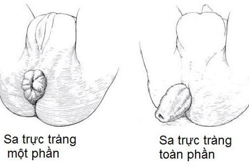 
Một số trường hợp sa trực tràng cũng có thể dẫn đến tình trạng đại tiện ra máu
