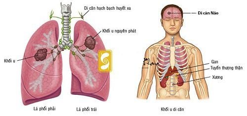 Sử dụng thuốc có thể tiêu diệt được tế bào ung thư phổi giai đoạn 4 không?