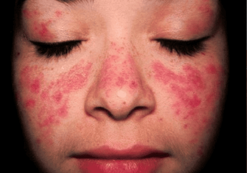 
Phát ban hình cánh bướm (Malar rash) dọc trên má và mũi là dấu hiệu đặc trưng của lupus ban đỏ
