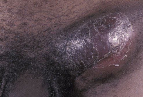 Pictures and information about sexually transmitted diseases (STDs)