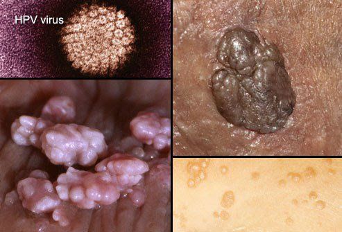 
Mụn cóc sinh dục (HPV)
