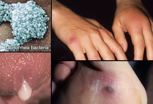 
Bệnh lậu gây ra bởi vi khuẩn lậu có tên khoa học là Neisseria gonorrhoeae
