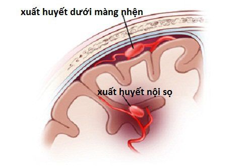 
Hình ảnh mô tả dấu hiệu chảy máu dưới nhện quanh não giữa
