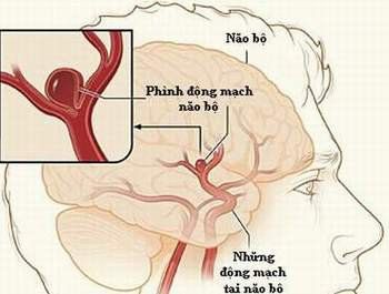 
Chụp số hóa xóa nền được áp dụng để chẩn đoán các bệnh mạch máu
