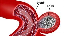 
Dùng nút coil nội mạch để điều trị phình động mạch
