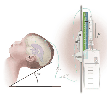 Cranial defect patch surgery in traumatic brain injury