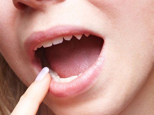 Nổi mụn trên lưỡi có nguy hiểm không?