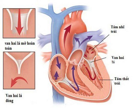 
Bệnh lý hở van động mạch chủ rất nguy hiểm
