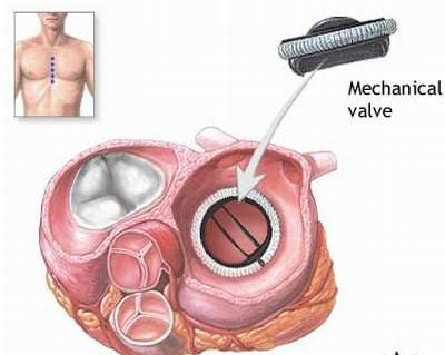 Benefits and risks of heart valve replacement surgery