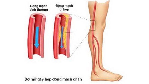 Bệnh tắc động mạch cấp tính ở chi