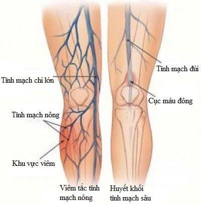 
Huyết khối động mạch làm tắc động mạch nuôi chi
