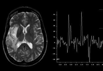 Magnetic resonance imaging of the brain (spect rography)