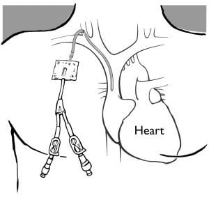 Placement of a central venous catheter (central venous catheter)