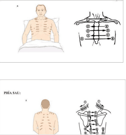 
Chọc hút khí màng phổi là 1 kỹ thuật thường thực hiện ở các khoa hồi sức cấp cứu
