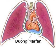 
Đường chọc dò Marfan
