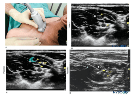 Methods of anesthesia of the brachial plexus