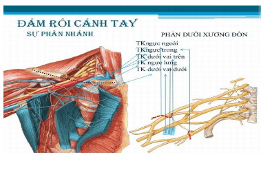 Methods of anesthesia of the brachial plexus