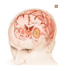 
U não gây thất điều tiểu não
