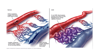 Arteriovenous malformations should be taken and intervened to digitally erase the background