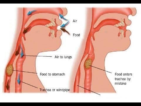 
Nếu hít sặc chu phẫu là thức ăn, dị vật, nhất là dịch acid của dạ dày có thể làm bỏng,, dày dính cản trở sự dẫn, trao đổi oxy trong đường hô hấp
