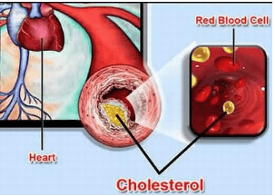 
Mỡ máu cao là khi thành phần Cholesterol trong máu tăng cao
