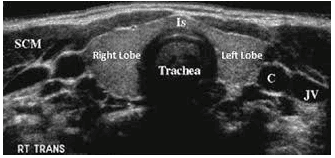 
Hình 1: Siêu âm tuyến giáp bình thường.
