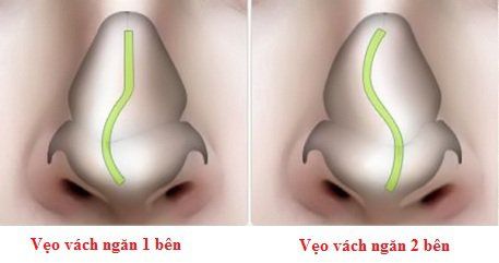 Deviated nasal septum: Causes, symptoms and treatment