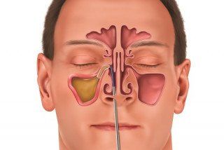 
Introduce liquid medicine into the anterior and posterior ethmoid sinuses through the air vent
