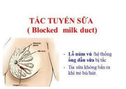 Treatment of blocked milk ducts after birth with physical therapy