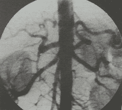 Digital imaging to erase the background and embolize the vascular malformations in the treatment of arteriovenous malformations