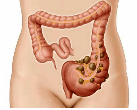 Learn about diverticulitis