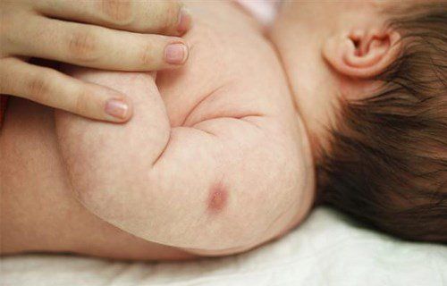 Trẻ 4 tháng tuổi tái phát mưng mủ nhiều lần sau tiêm phòng vắc-xin phòng lao chưa thành sẹo có làm sao không?
