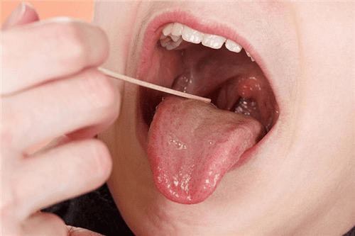 
Tonsillitis can cause chronic otitis media with perforated eardrum
