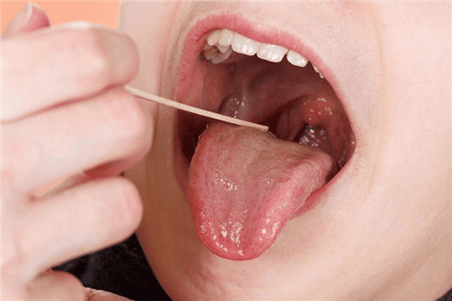Phương pháp điều trị viêm amidan đáy lưỡi