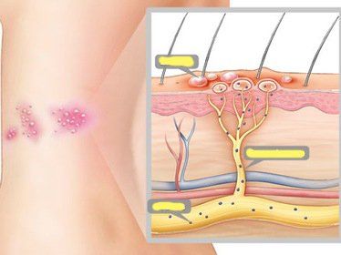 Nên làm gì khi đau thần kinh sau Zona không thể kiểm soát?