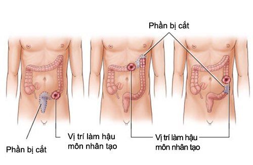 
Cần phẫu thuật mổ bụng cắt đoạn trực tràng để điều trị vết thương hậu môn trực tràng nếu trực tràng dập nát
