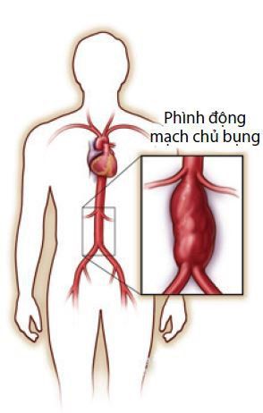 Triệu chứng chảy máu ổ bụng do phình động mạch chủ bụng vỡ