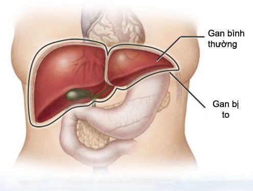 Hepatomegaly: Symptoms, diagnosis, treatment