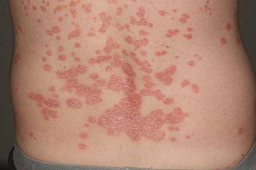 Guttate psoriasis: Causes, stages, symptoms, treatment