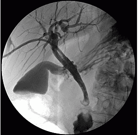 Capture and place a digital biliary stent to erase the DSA . background