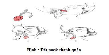 
Đặt mask thanh quản
