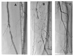 Superficial femoral artery intervention: What you need to know