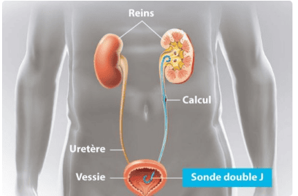 Percutaneous ureteral stent placement under background erasure digital angiography