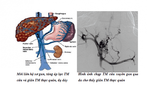 Esophageal varices have how many degrees?