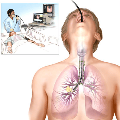 Bronchoscopy for the diagnosis and treatment of respiratory diseases